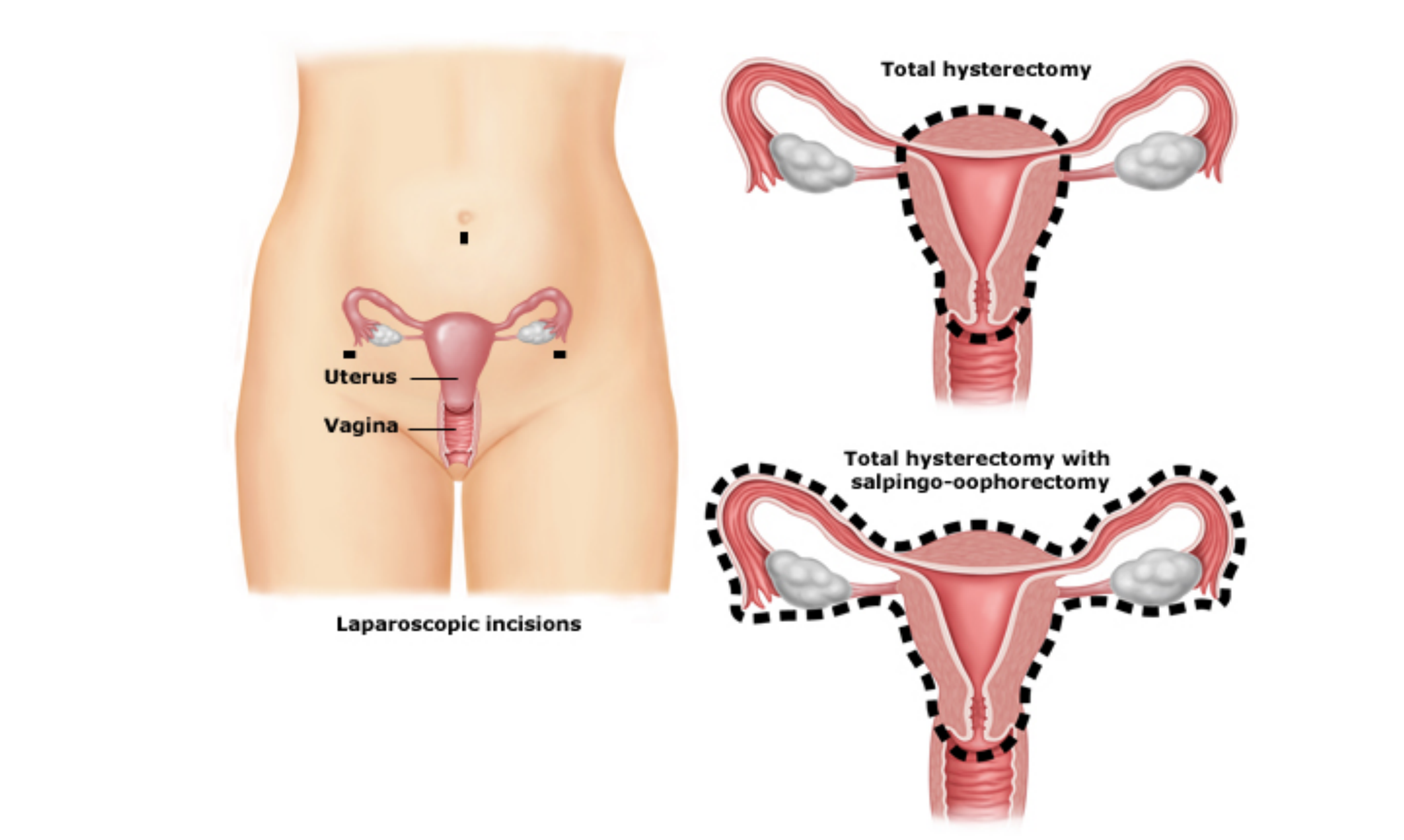 Diagram of Hysterectomy